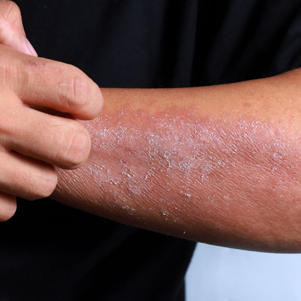 ECZEMA AND PSORIASIS. Are They Related?