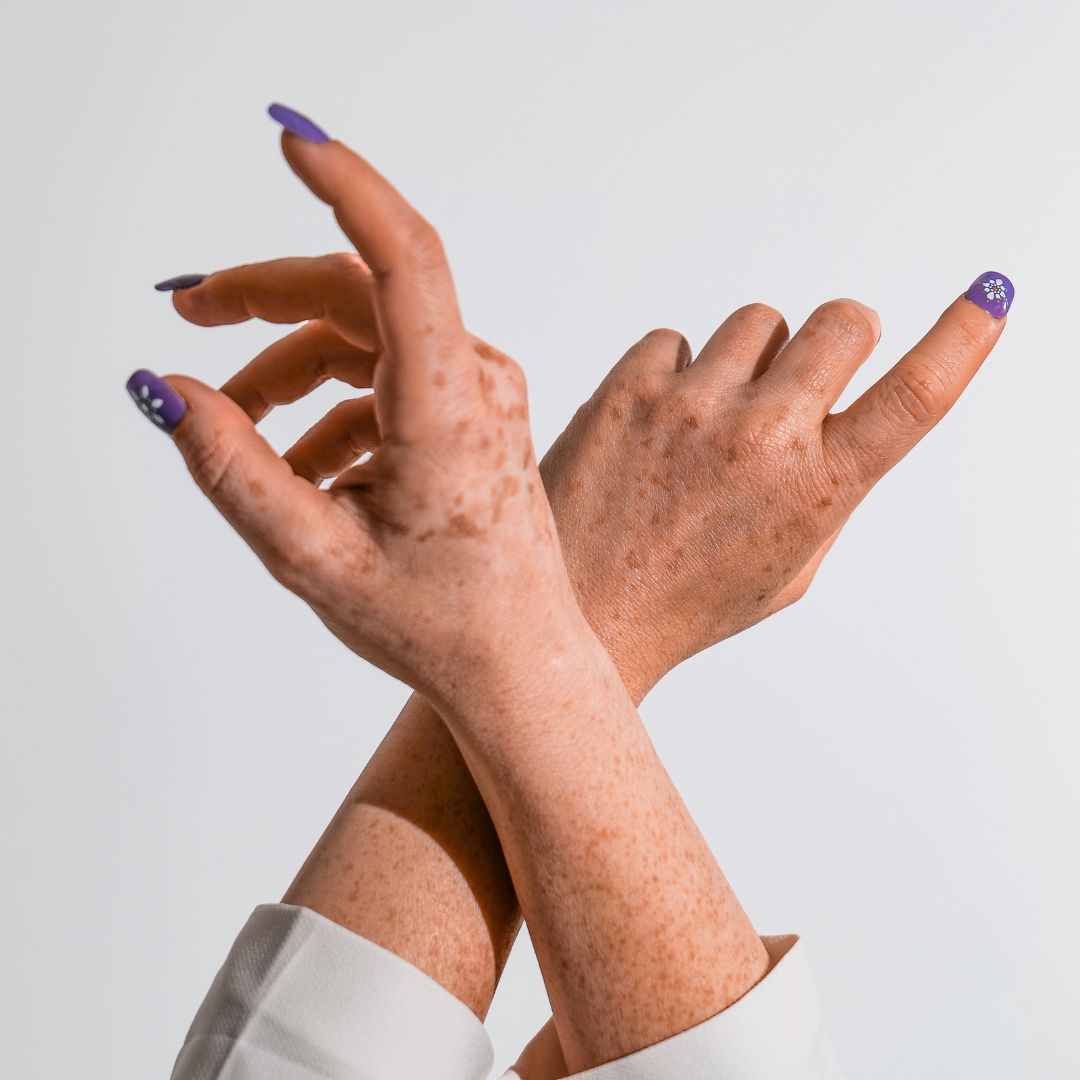 DIFFERENCES BETWEEN ECZEMA, PSORIASIS, ROSACEA AND DERMATITIS.