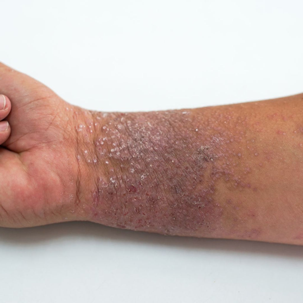 What To Do When Your Eczema Is Spreading