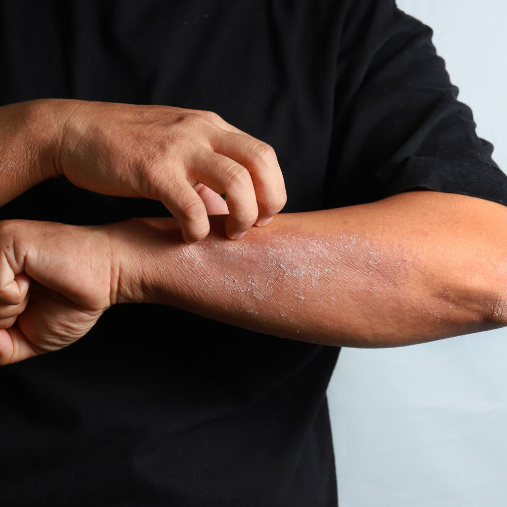 How Eczema Looks On Different Skin Tones