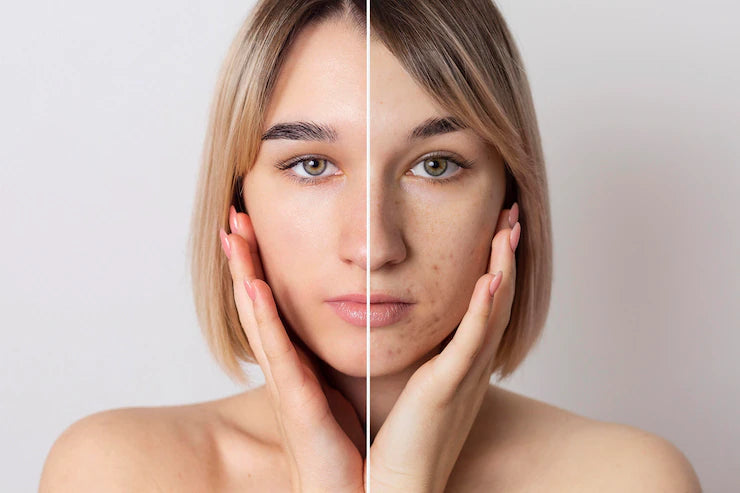Improve Uneven Skin Tone by Doing These 5 Things
