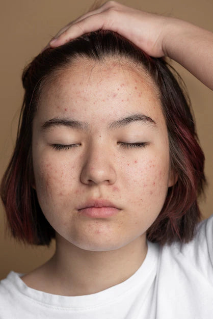 4 Good Reasons Not To Pop Your Pimples No Matter How Tempted You Are